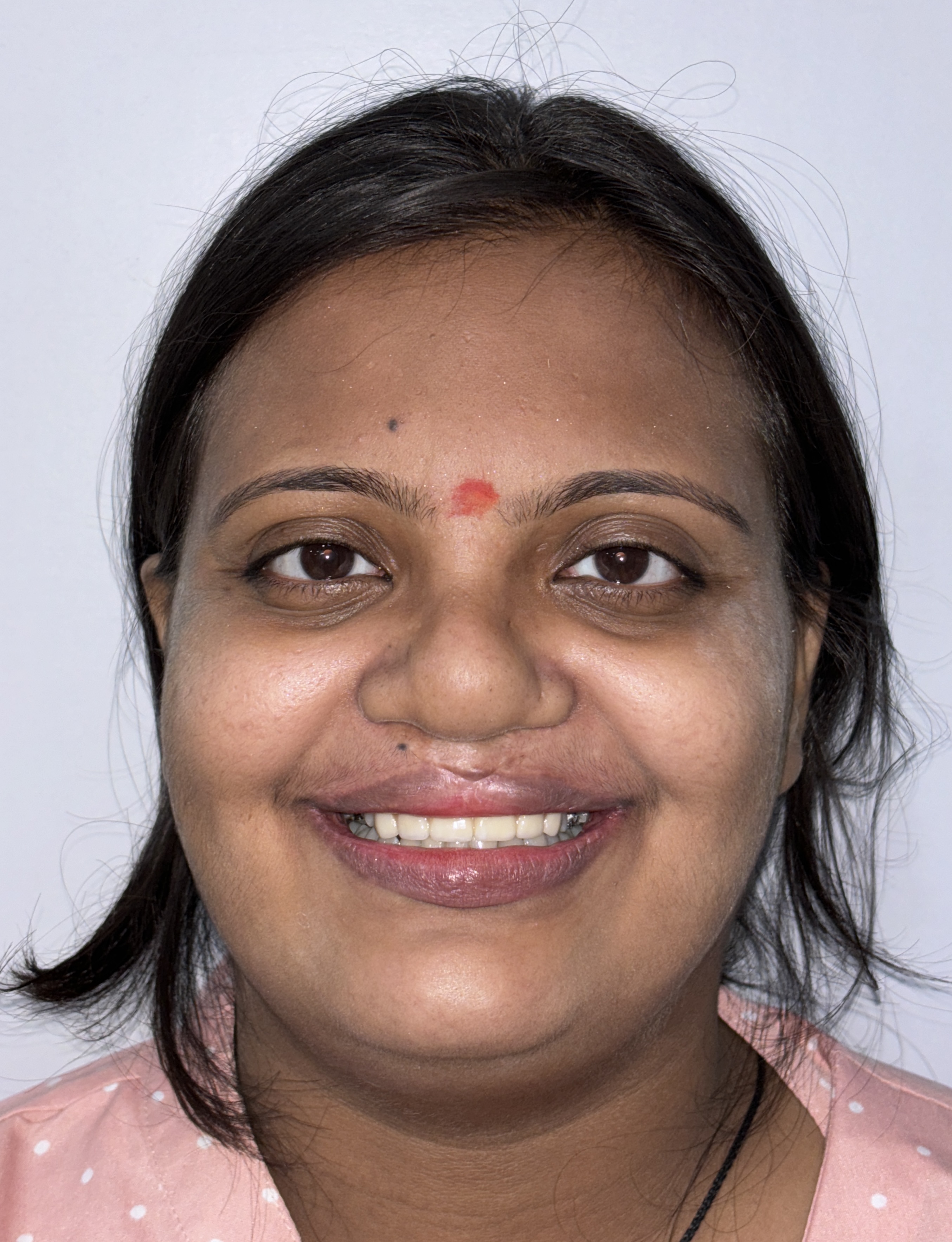 Rehabilitation of Cleft Patient - After Comprehensive Treatment